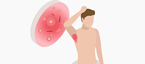 Hidradenitis Suppurativa Diagnosis and Treatment in Rolling Hills Estate, CA