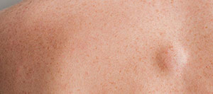 Lipoma Removal Specialist in Rolling Hills Estates, CA
