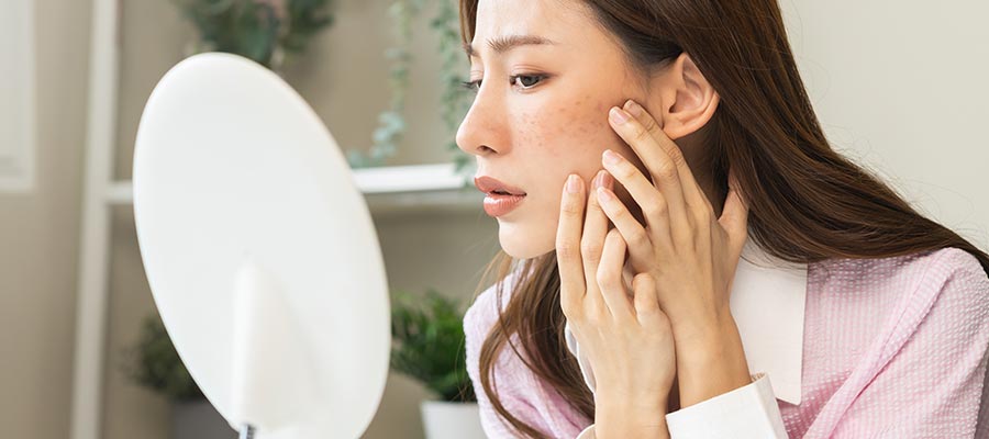 Melasma in Rolling Hills Estates, CA