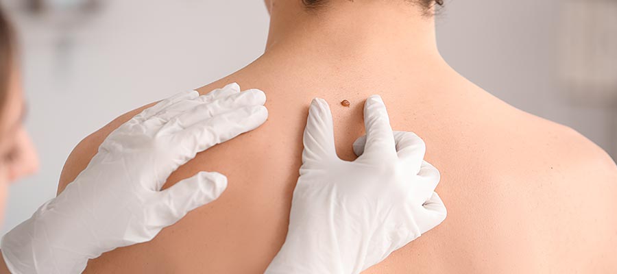 Atypical Nevus (Moles) Treatment Near Me in Rolling Hills Estates, CA