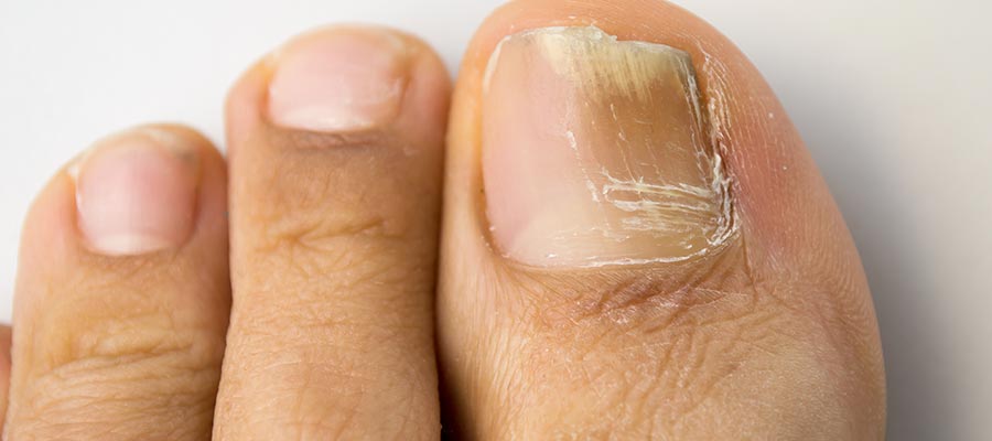 Onychomycosis (Nail Fungus) in Rolling Hills Estates, CA