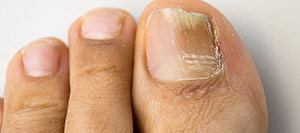 Onychomycosis (Nail Fungus) in Rolling Hills Estates, CA
