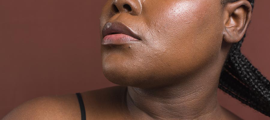 Pigmentation Disorders in Rolling Hills Estates, CA