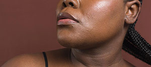 Pigmentation Disorders in Rolling Hills Estates, CA