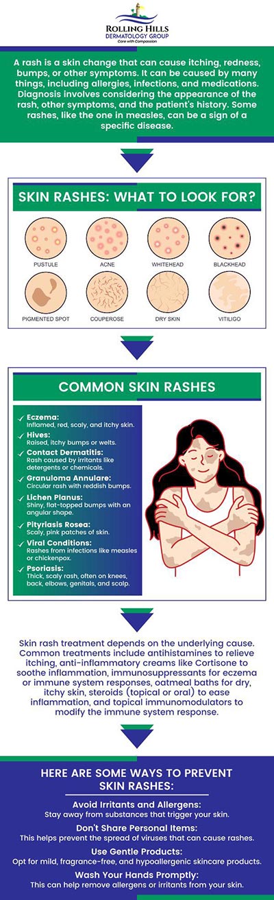 Common questions asked by patients: What causes skin rashes? How do I know if my skin rash is serious? Can a skin rash be a sign of an allergy? When should I see a specialist for a skin rash? For more information, contact us or request an appointment online. We are conveniently located at 449 Silver Spur Road, Rolling Hills Estates, CA 90274. We serve patients from Rolling Hills Estate CA, Torrance CA, West Carson CA, Lomita CA, Palos Verdes Estates CA, Hermosa Beach CA, Manhattan Beach CA, Redondo Beach CA, and surrounding areas.