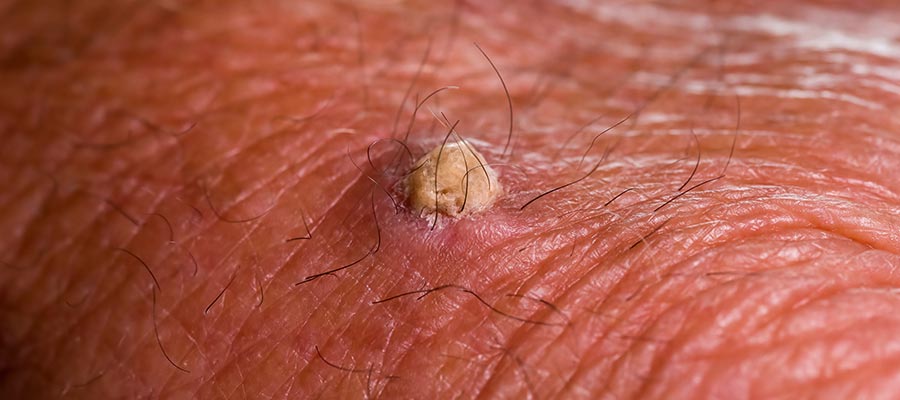 Squamous Cell Carcinoma in Rolling Hills Estates, CA