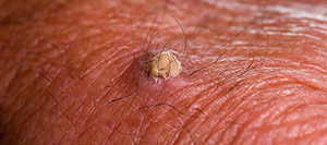 Squamous Cell Carcinoma in Rolling Hills Estates, CA