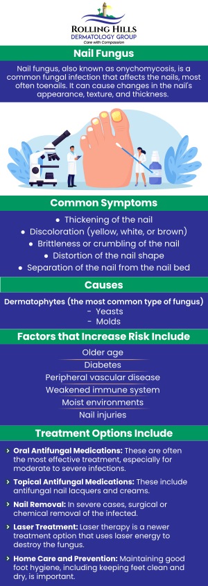 Onychomycosis (Nail Fungus) in Rolling Hills Estates, CA